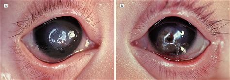 Advanced Keratomalacia With Descemetocele In An Infant With Cystic