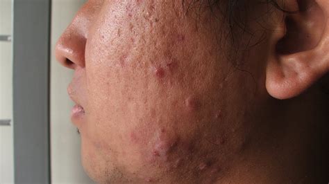 What Is Cystic Acne Acne Treatment Youtube