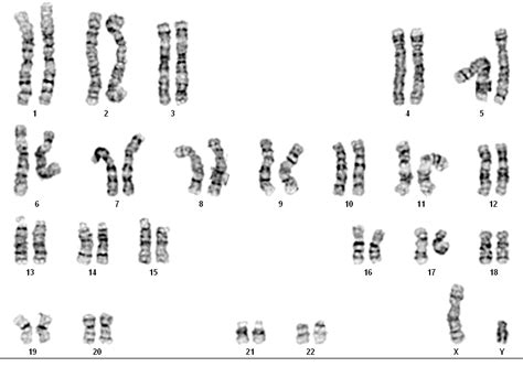 Angelman Syndrome Karyotype Chromosome 15 Acne Symptoms Images And