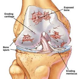 Knee Osteoarthritis Degenerative Arthritis Kintec