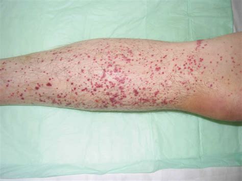 Red Spots On Skin Petechiae