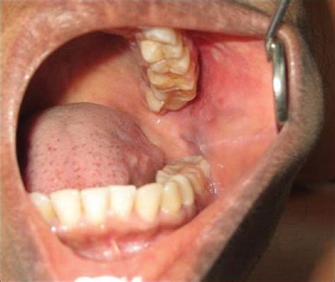 Swelling On The Left Buccal Mucosa Without Any Inflammatory Signs