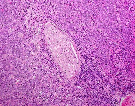 Poorly Differentiated Squamous Cell Carcinoma Of The Larynx With