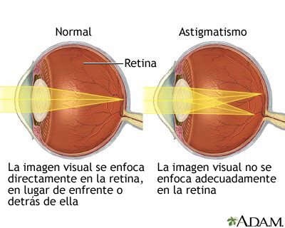 Qu Es El Astigmatismo Explicaci N Del Astigmatismo Vlr Eng Br