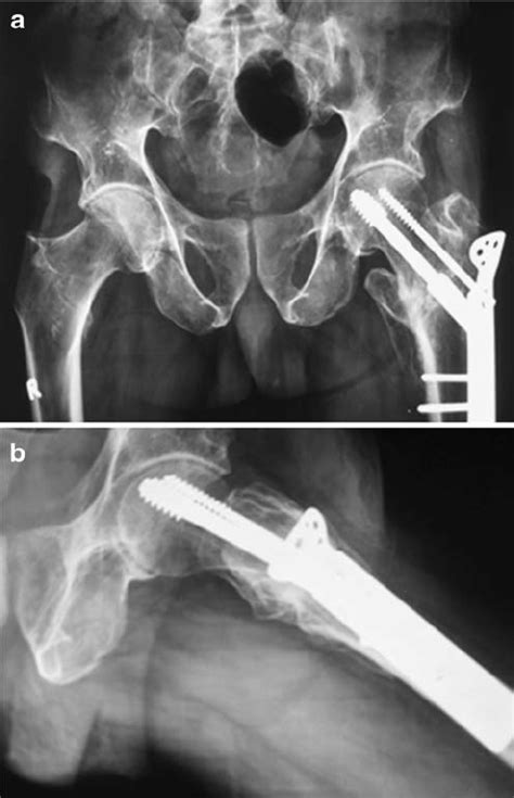 Dynamic Hip Screw Dhs Supplemented By Trochanteric Stabilisation