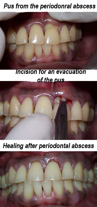 Treatment Of A Periodontal Abscess Ralev Dental Clinic