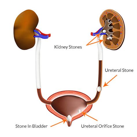 They won't make any cuts in your skin, but you will be asleep during this procedure. Kidney Stones