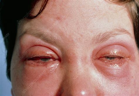 Womans Eyes Inflamed Due To Make Up Allergy Stock Image M3200137