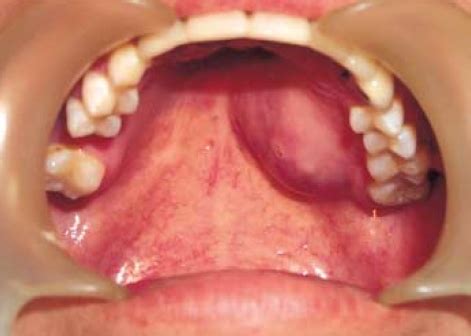 Bumps that are cancerous are typically large, hard, painless to the touch and appear spontaneously. A nodular submucosal tumor is noted on the left side of ...