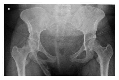 X Ray Of The Pelvis With A Pubic Symphysis Separation Is Shown In A Download Scientific