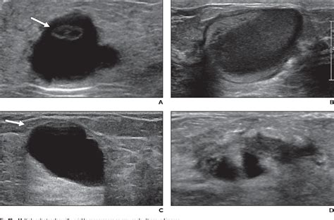 Figure 10 From Breast Imaging Of The Pregnant And Lactating Patient