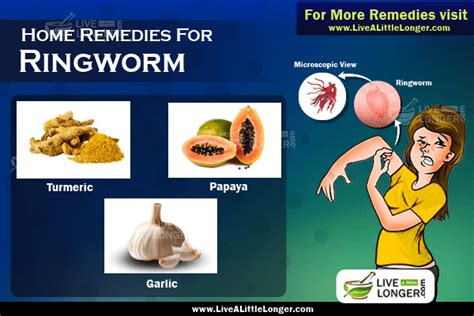 10 Incredible Home Remedies For Ringworms