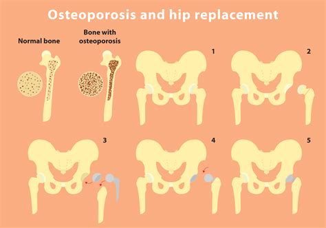 Osteoporosis And Hip Replacement Vector Info Download Free Vector Art