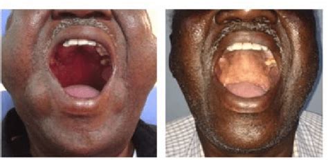 A Patient Presenting With Bilateral Enlargement Of Parotid And Minor