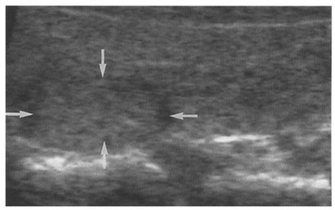 Ultrasound Of The Thyroid Longitudinal Showing An Isoechoic Nodule