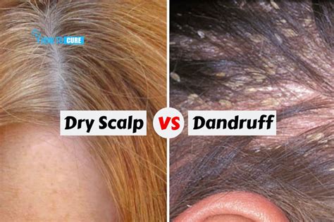 Dandruff Vs Dry Scalp The Difference And Treatment How To Cure