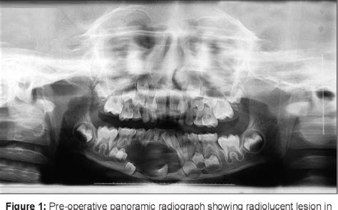 Figure 1 From Management Of Unicystic Ameloblastoma Of The Mandible In