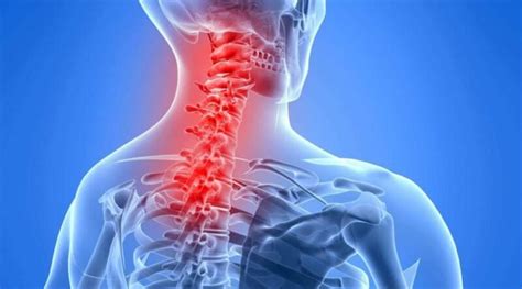 Neck Muscle Strain From Sleeping Archives Samarpan Physiotherapy