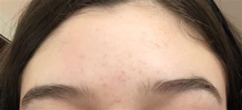 Routine Help I Have Had These Small Brown Dark Spots On My Face For
