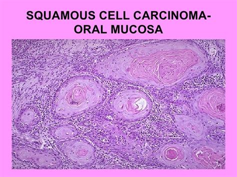 Squamous Cell Carcinoma Histology Oral Cavity Histologic Subtypes Of