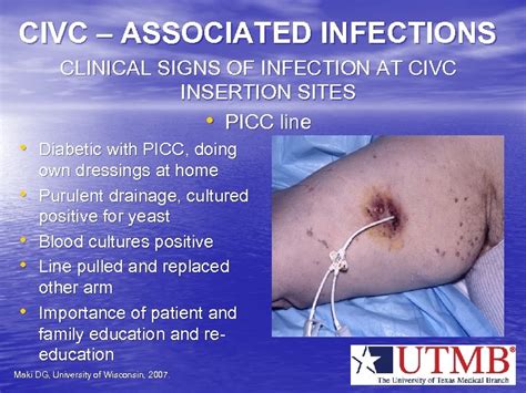 Arm Picc Line Infection Mike Dunne