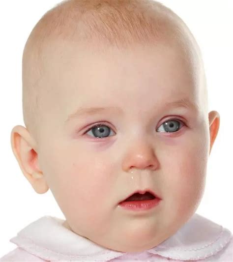 Pink Eye In Babies Signs Causes And Treatment