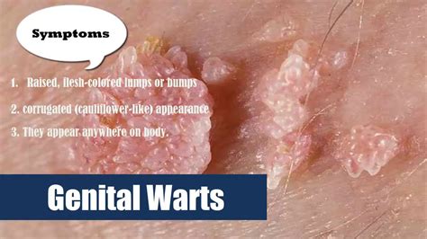 Genital Warts Hpv Human Papilloma Virus In Women And Men Symptoms Youtube