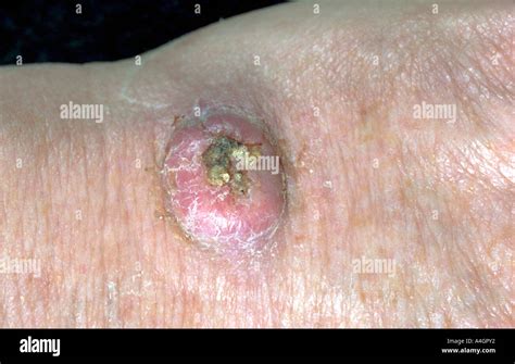 ein foto von einem plattenepithelkarzinom scc nach dem basalzellkarzinom der zweithäufigste