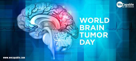 World Brain Tumor Day Risk Factors And Symptoms Of Brain Tumor
