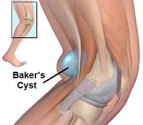 It band, runner's knee and meniscus recommendations included. Pain Behind The Knee: Diagnosis & Treatment - Knee Pain ...