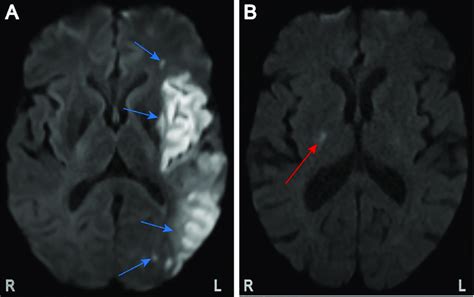 Sample Patient Brain Magnetic Resonance Images Demonstrating Acute