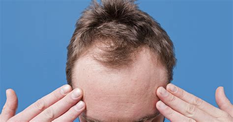 how to deal with male pattern baldness