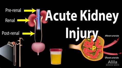 Acute Kidney Injury Causes Diagnosis And Treatments Ph