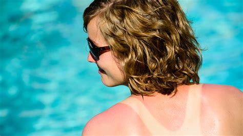 Put Out The Fire Tips For Treating Sunburn Ohio State Wexner Medical Center