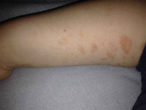My 4 Yr Old Had Infected Eczema Behind Both Knees Was Given