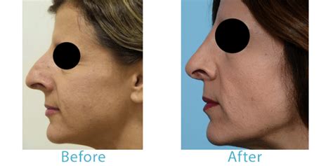 Why I Prefer To Perform Open Rhinoplasty Procedures Tlkm Plastic Surgery