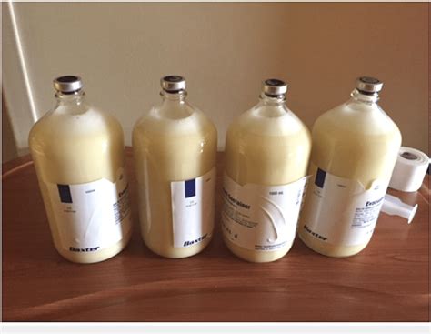 Four Liters Of Milky White Appearing Peritoneal Fluid On Paracentesis