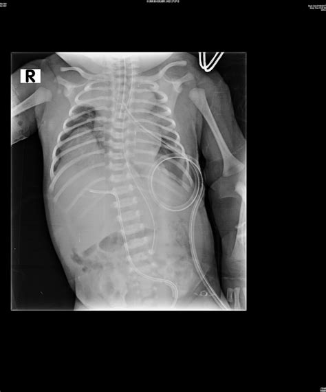 Bilateral Congenital Eventration Of Diaphragm Keep In Mind The Other