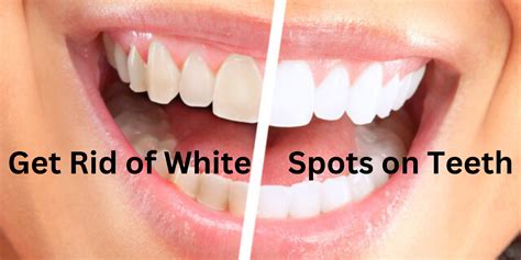 White Spots On Teeth How To Get Rid Of White Spots On Teeth