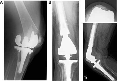 Indications Survivorship And Clinical Outcomes Of A Rotating Hinge