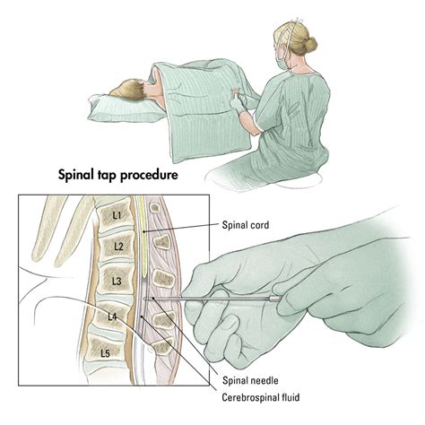 Procedural Specifics Spinal Tap Aka Lumbar Puncture