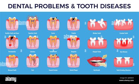 Dental Problems Educational Infographic Info Chart Set With Caries
