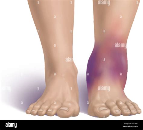 Swelling And Bruising Of The Ankle Stock Photo 7710670 Alamy