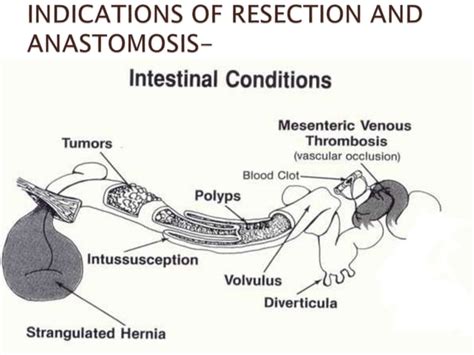 Resection And Anastomosis Of Bowel Its Complications Pranaya Ppt