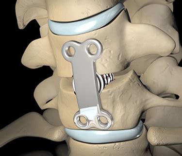 Learn how the surgeon will perform the fusion and how it will help your how does a fusion actually improve your pain? Spinal Fusion Procedure | Health Life Media