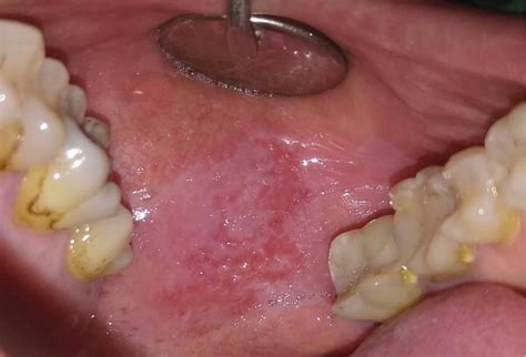 Fig 1 The Lesion As Appeared Before The Lllt It Had A Reddish