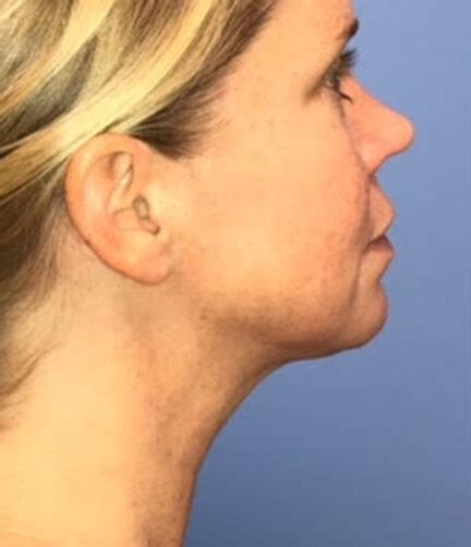 Before And After Kybella Double Chin Treatment In Atlanta And Dallas