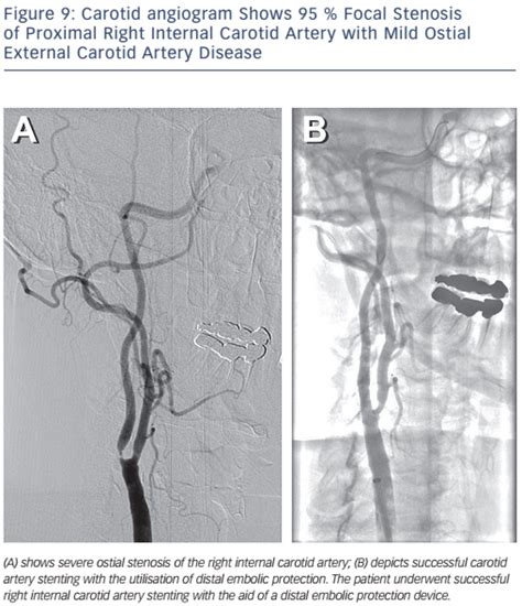 Figure 9 Carotid Angiogram Shows 95 Focal Stenosis Of Proximal Right