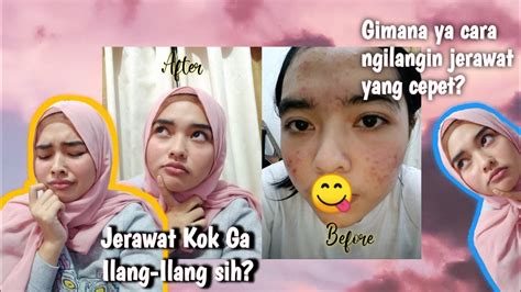 Pada dasarnya cara menghilangkan jerawat batu hampir sama dengan cara menghilangkan jerawat biasa. Cara Menghilangkan Jerawat dan bekasnya dengan cepat ...
