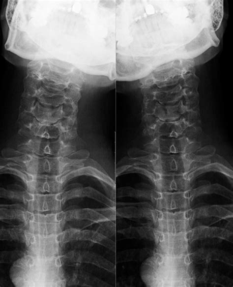 Preoperative Cervical Antero Posterior Lateral Bending Radiographs